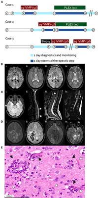 Case Series: Acute Hemorrhagic Encephalomyelitis After SARS-CoV-2 Vaccination